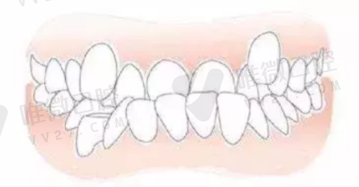 安假牙有几种材质的区别,牙都掉了能安假牙吗(图1)